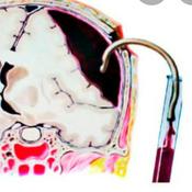 Podcast Drenaje de Hematoma Epidural